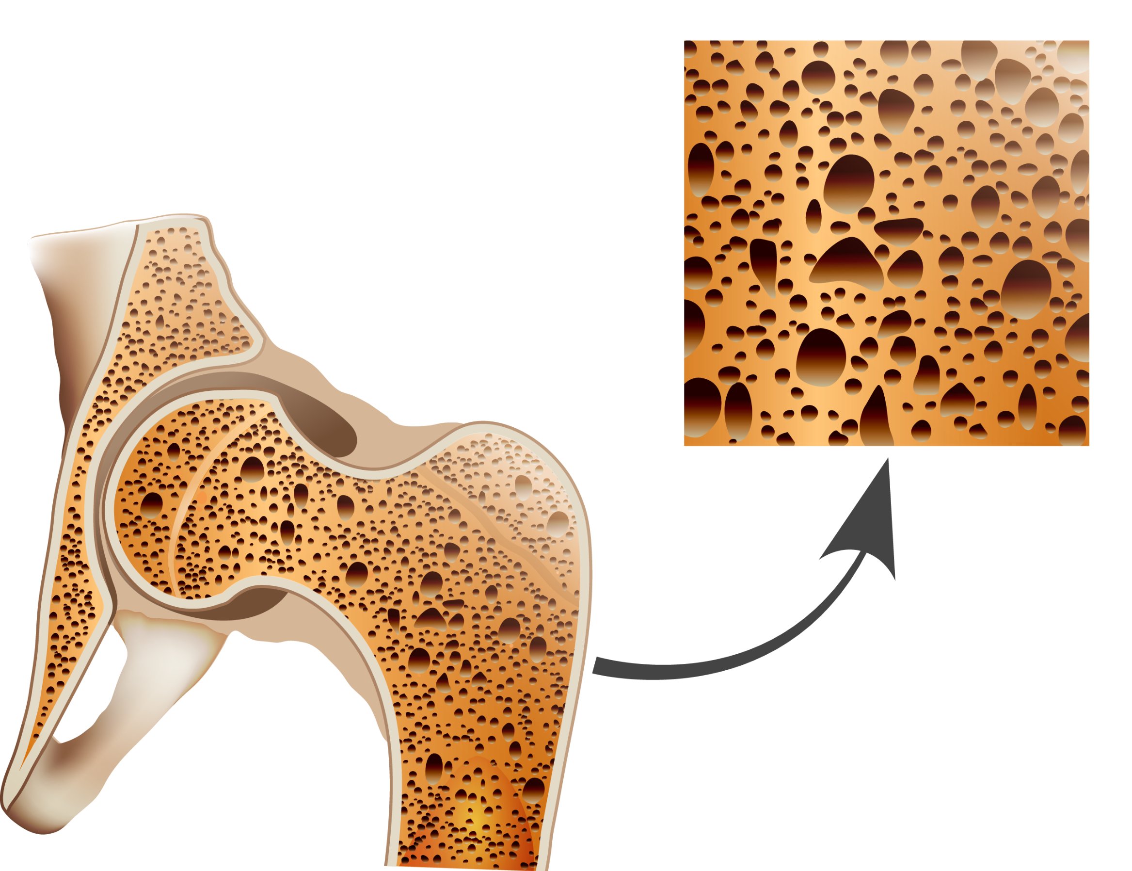 Ostéoporose, densité osseuse